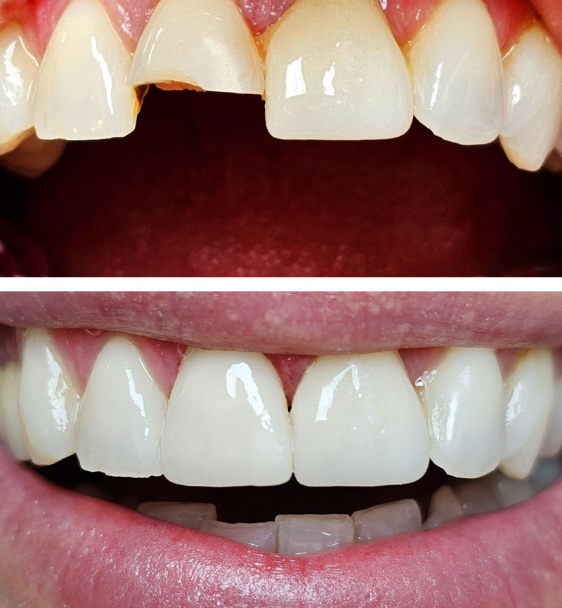 Nový úsmev za 1 deň :: Dr.Peter.Svoboda